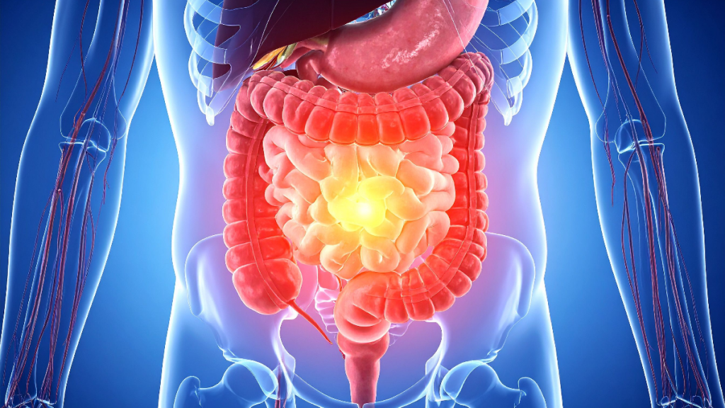 The FODMAP Factor